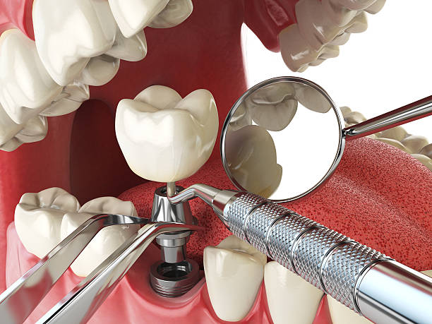 Best Emergency Broken Tooth Repair in Crowley, LA